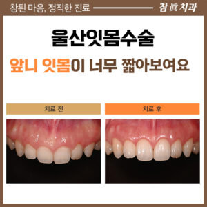 울산임플란트