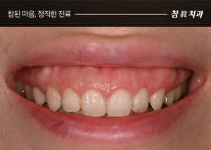 울산잇몸수술 