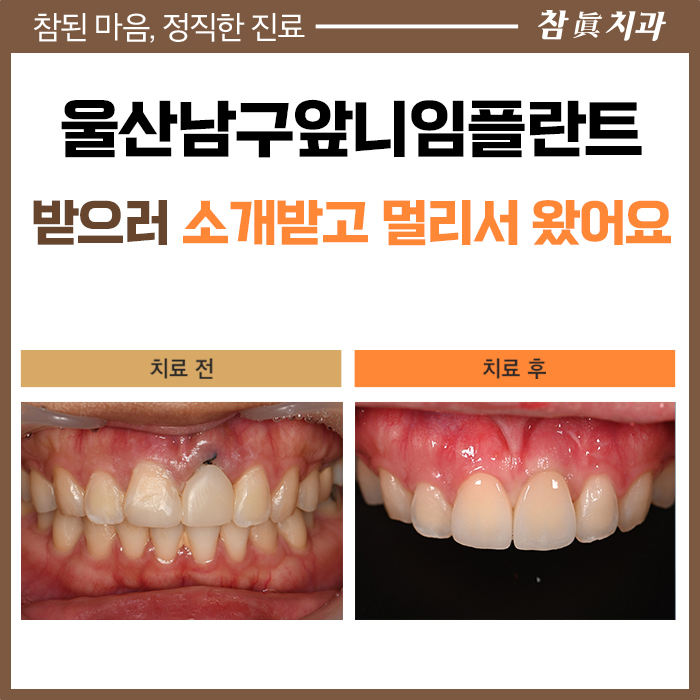 울산임플란트