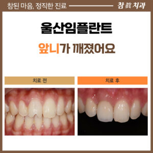 울산임플란트