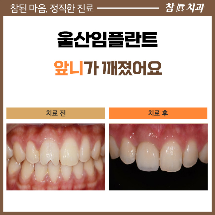 울산임플란트 