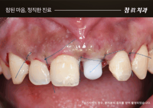울산임플란트