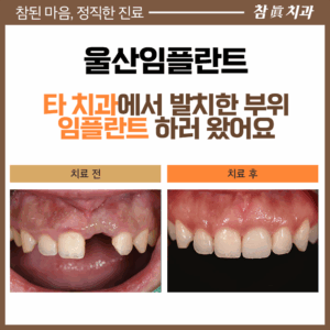 울산임플란트