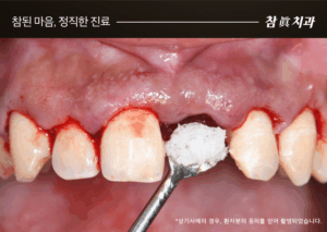 울산임플란트