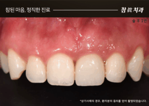 울산임플란트