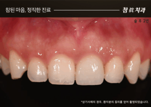 울산임플란트