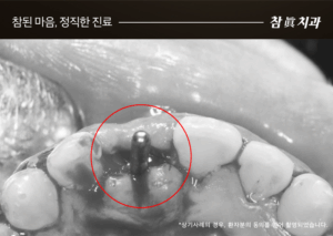 울산임플란트