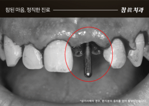 울산임플란트