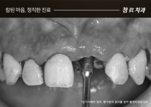 울산임플란트