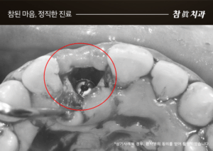 울산임플란트