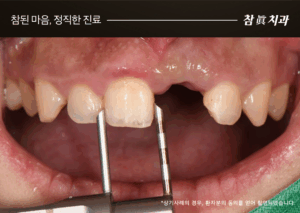 울산임플란트