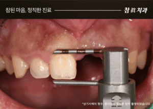 울산임플란트