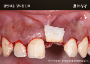 울산임플란트