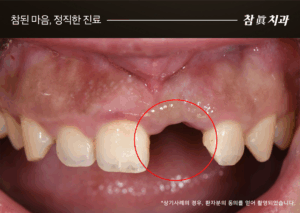 울산임플란트