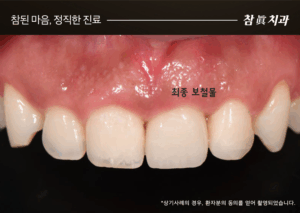 울산임플란트