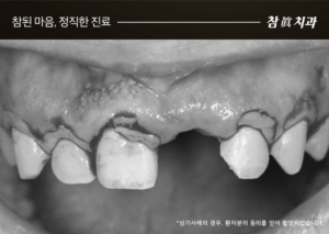울산임플란트