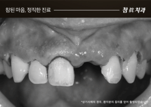 울산임플란트