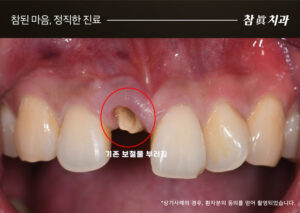 삼산동임플란트