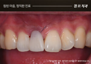 삼산동임플란트