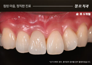 삼산동임플란트