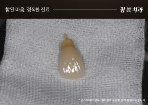 삼산동임플란트