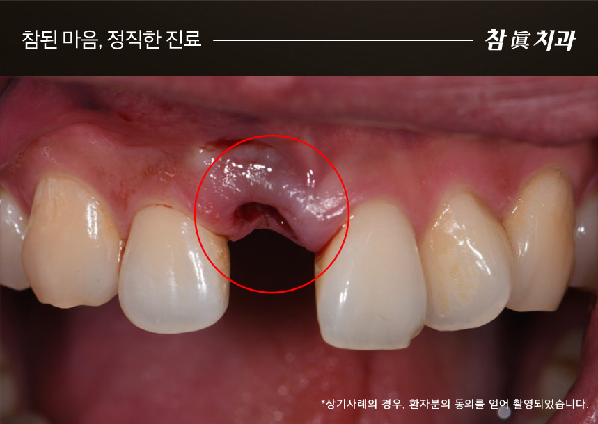 삼산동임플란트