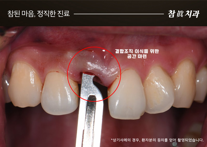 삼산동임플란트