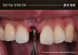 삼산동임플란트