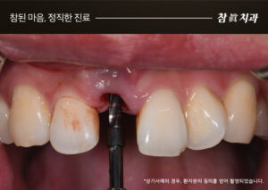 삼산동임플란트