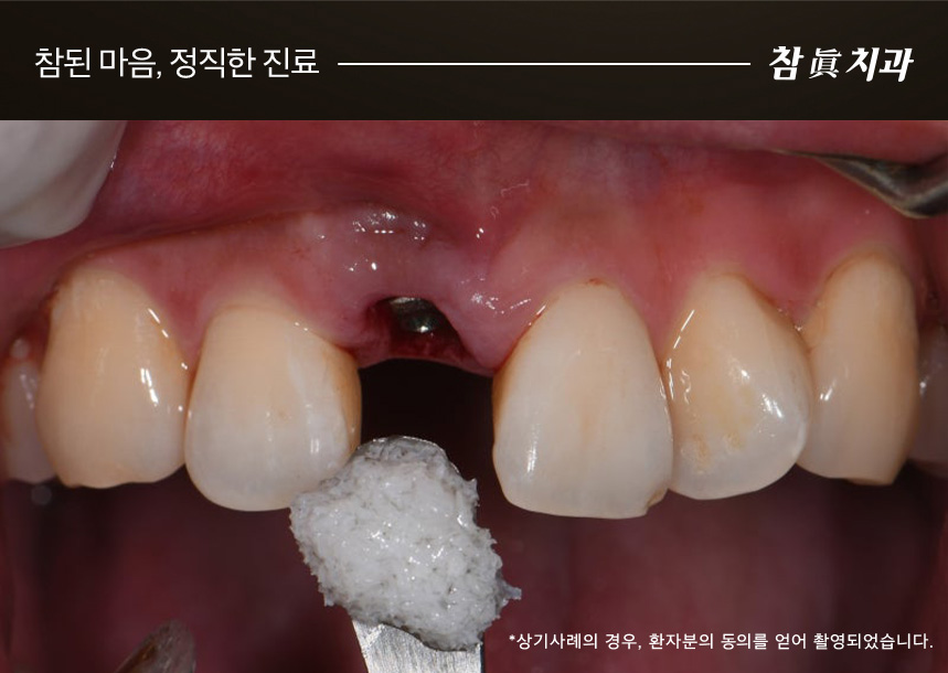삼산동임플란트