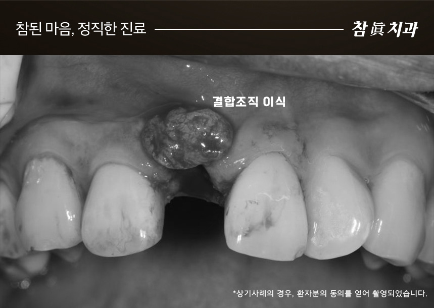 삼산동임플란트