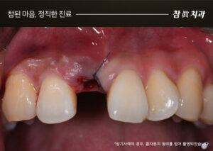 삼산동임플란트