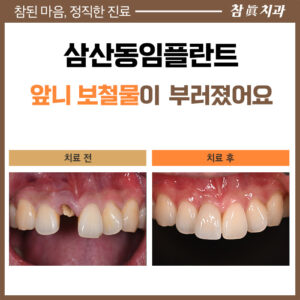 삼산동임플란트