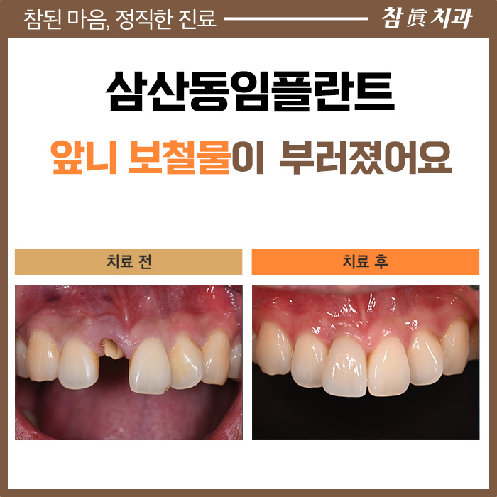 삼산동임플란트