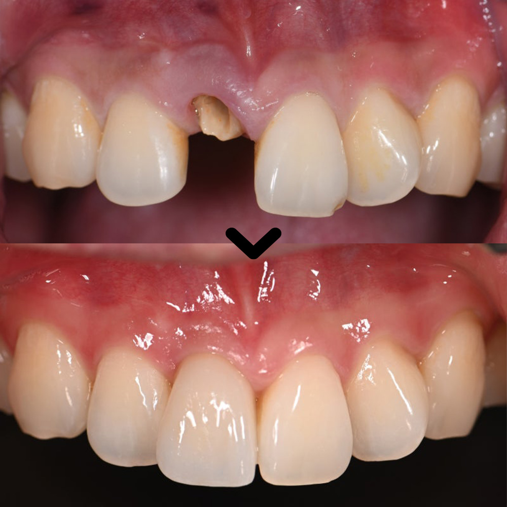 삼산동임플란트