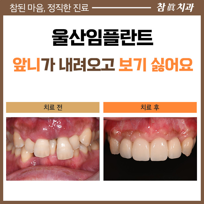 울산임플란트